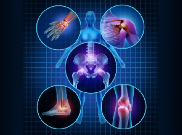 Arthritis Treatment